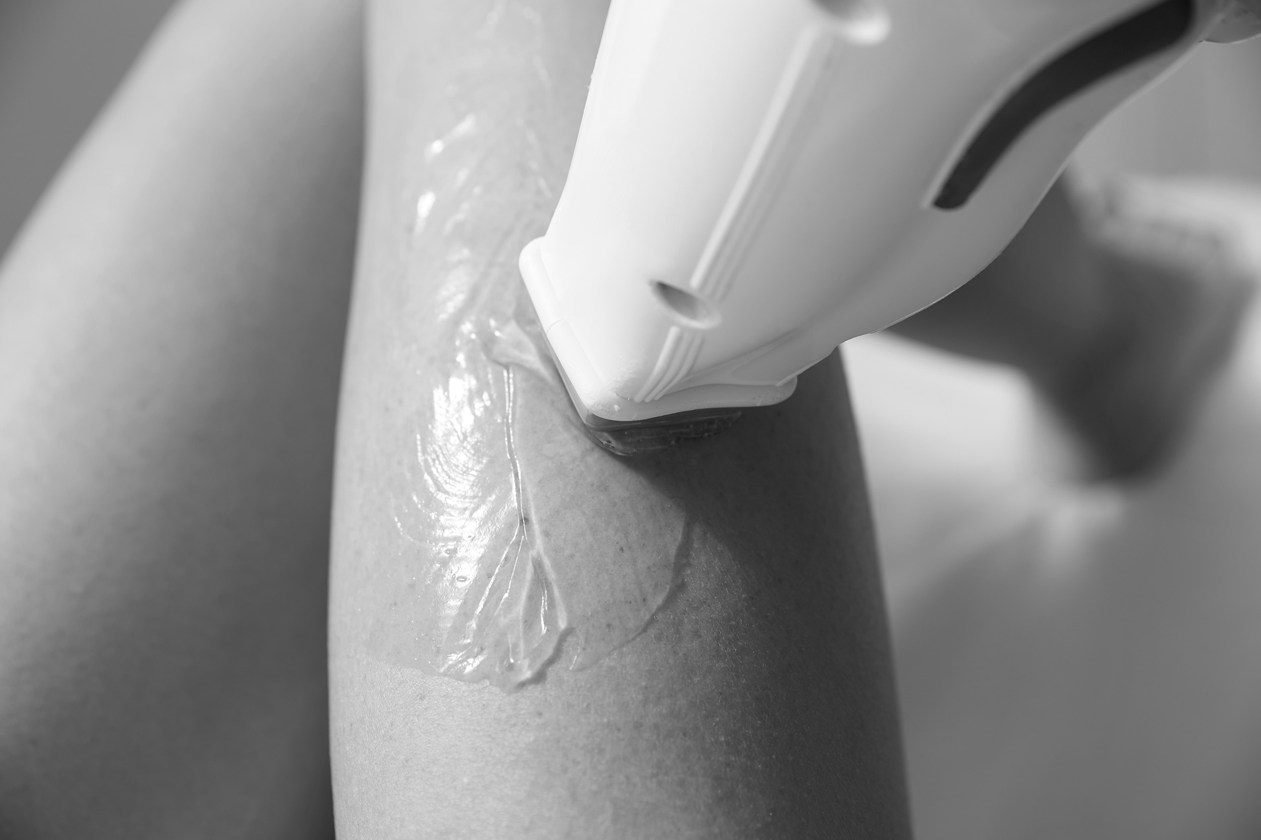 Laser-haarfjerning